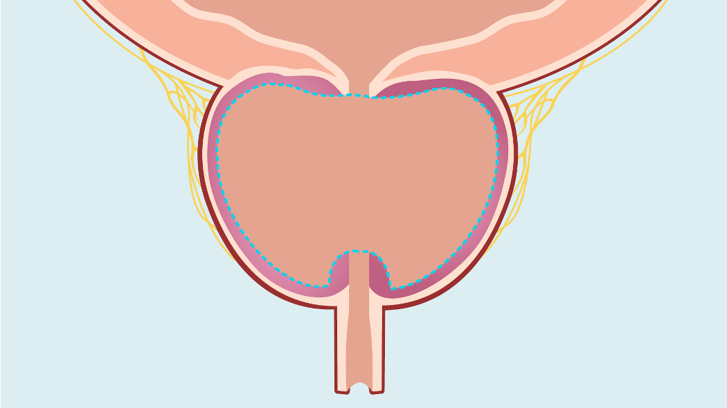 Illustration of a resected prostate