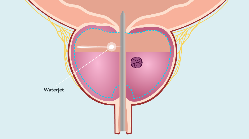 Illustration of waterjet resecting prostate tissue
